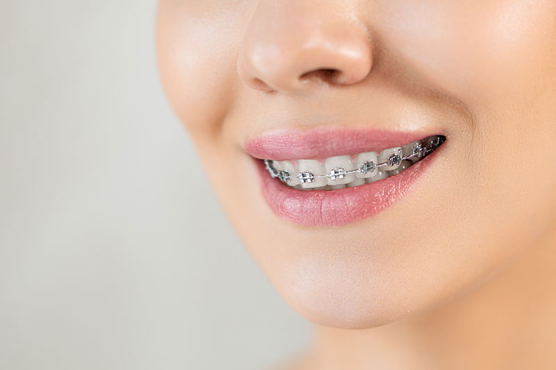 Braces in Norcross, Stockbridge & Lithia Springs