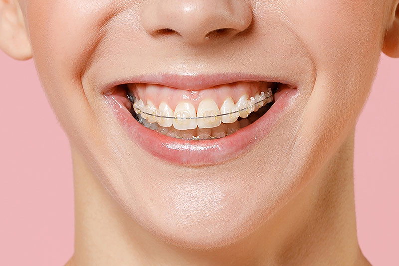 Clear Ceramic Braces in Norcross, Stockbridge & Lithia Springs
