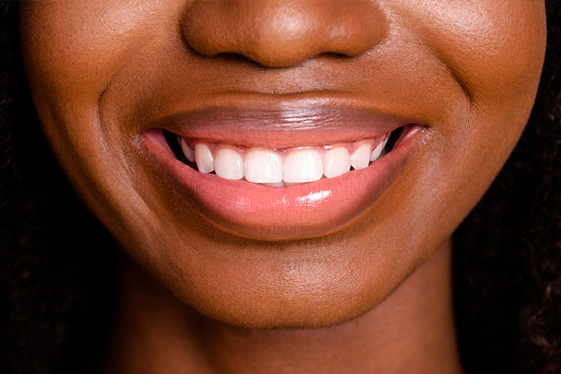 Gum Contouring in Norcross, Stockbridge & Lithia Springs
