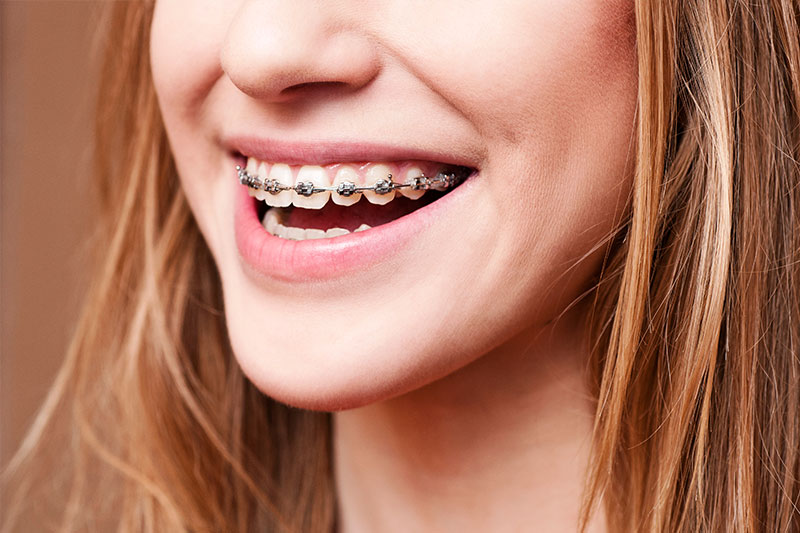 Orthodontics in Norcross, Stockbridge & Lithia Springs