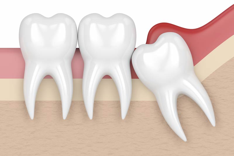 Wisdom Tooth Removal in Norcross, Stockbridge & Lithia Springs